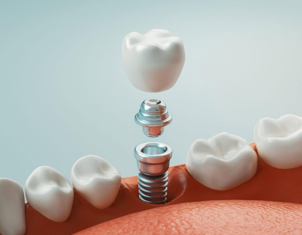 Zęby na&nbsp;implantach – co&nbsp;dzieje się zanim je&nbsp;wszczepimy?