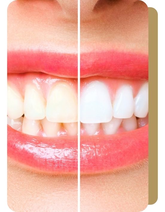 profilaktyka stomatologiczna i wybielanie zębów Częstochowa