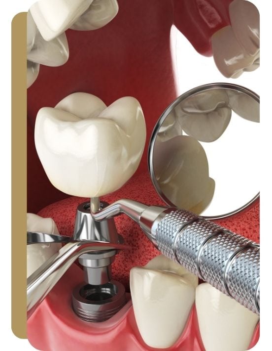 implanty zębowe Częstochowa